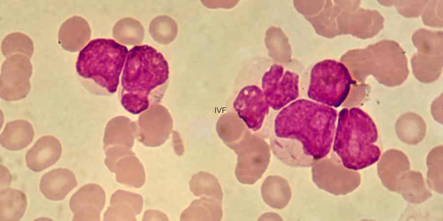 Successful treatment of childhood leukemia with CAR T-cells