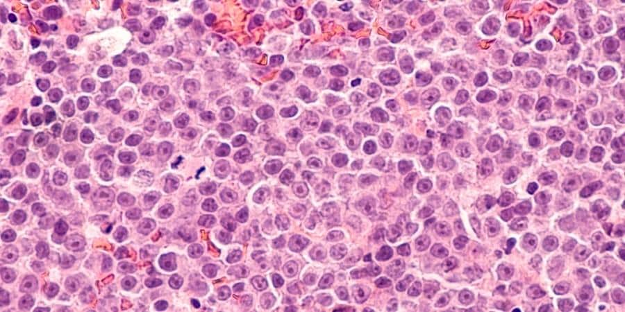 B-Cell Lymphoma in 30th Week of Pregnancy