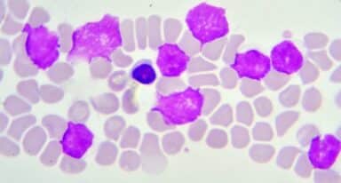 CAR-T Cell Therapy for AML Patients Has Been Developed at Sheba