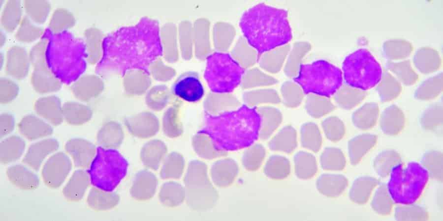 CAR-T Cell Therapy for AML Patients Has Been Developed at Sheba