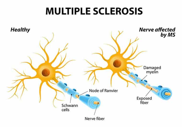 Multiple Sclerosis Treatment page