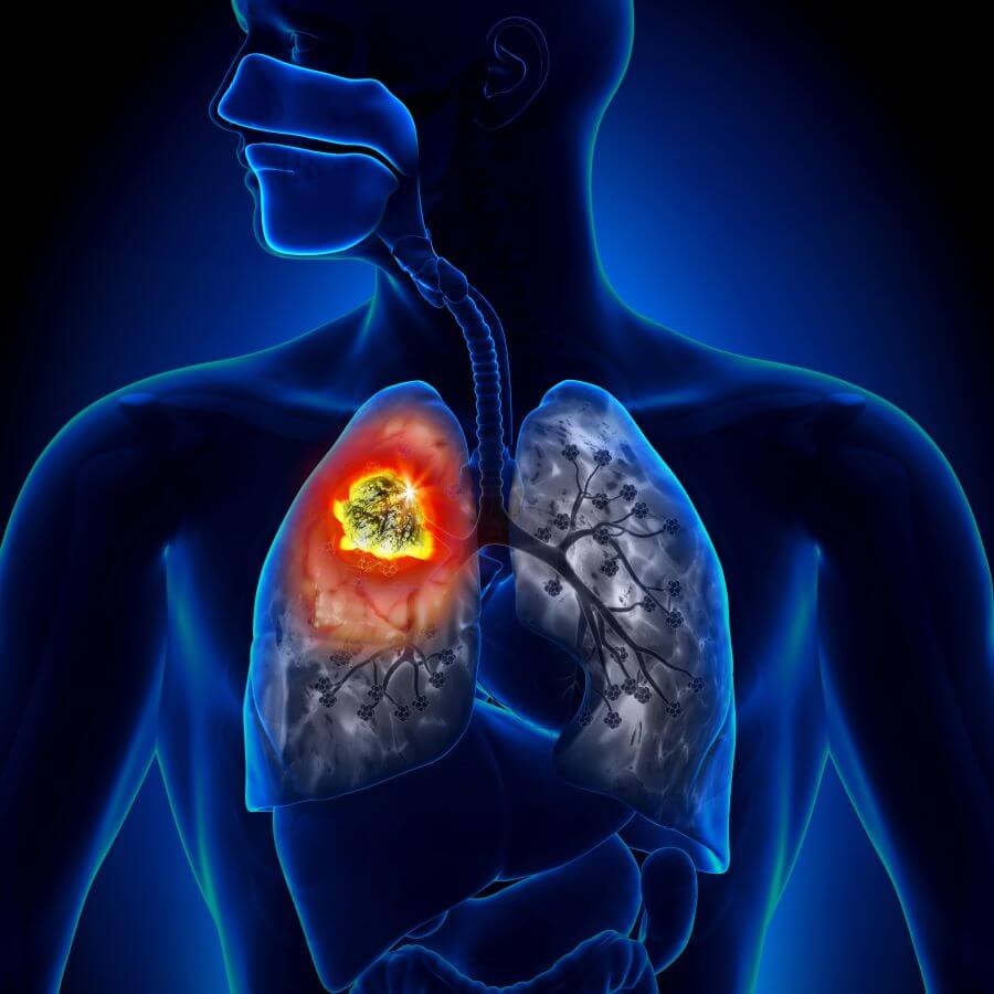 Early Detection of Lung Cancer – With 96% Less Radiation