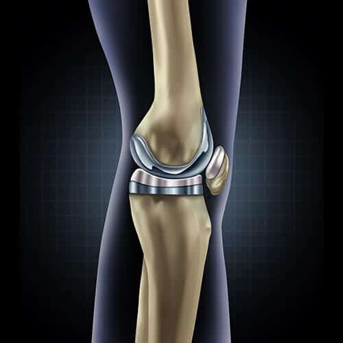 best country for knee replacement surgery