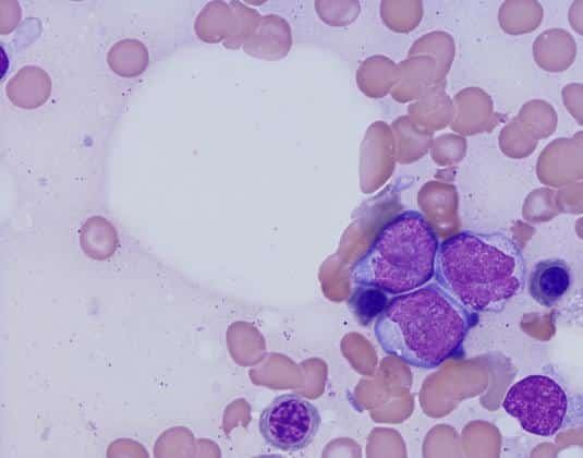 A microscopic look at Acute lymphocytic leukemia