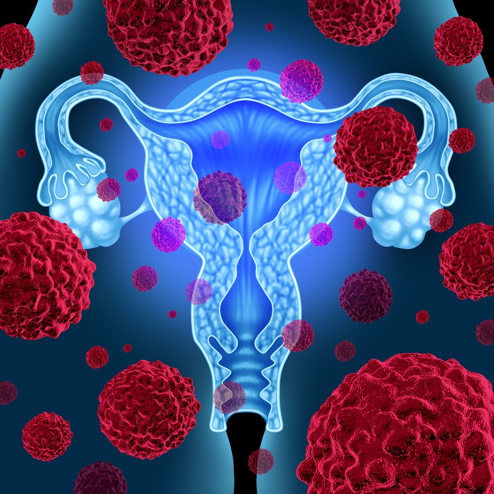 An illustration of cancer cells moving toward a biological representation of a womb. Cervical cancer.