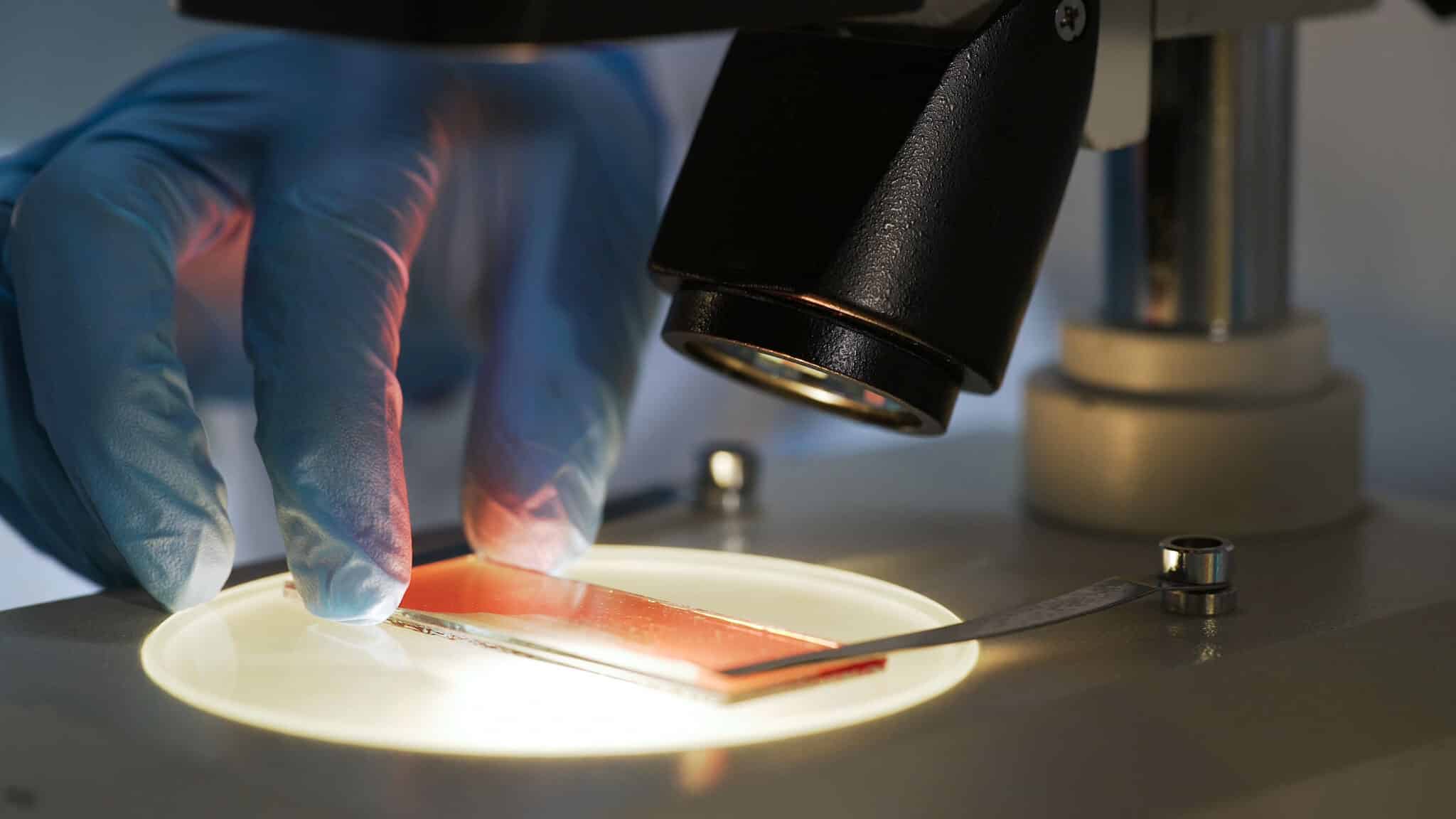 Doctor analyzing hemophilia blood with a microscope. The focus of the shot is on the blood.